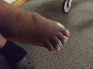 Tendai leg ulcer